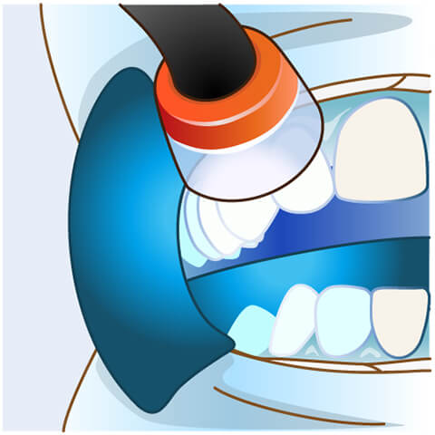 STEP4:	 歯以外の場所を保護し終えたら、ホワイトニング専用の光を当てます。