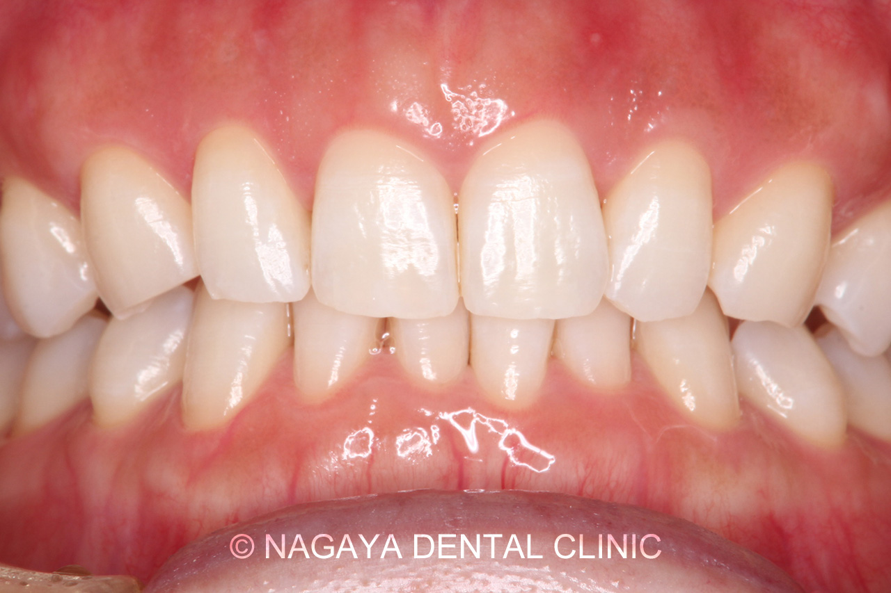 ホワイトニング症例 No.2(術後写真)