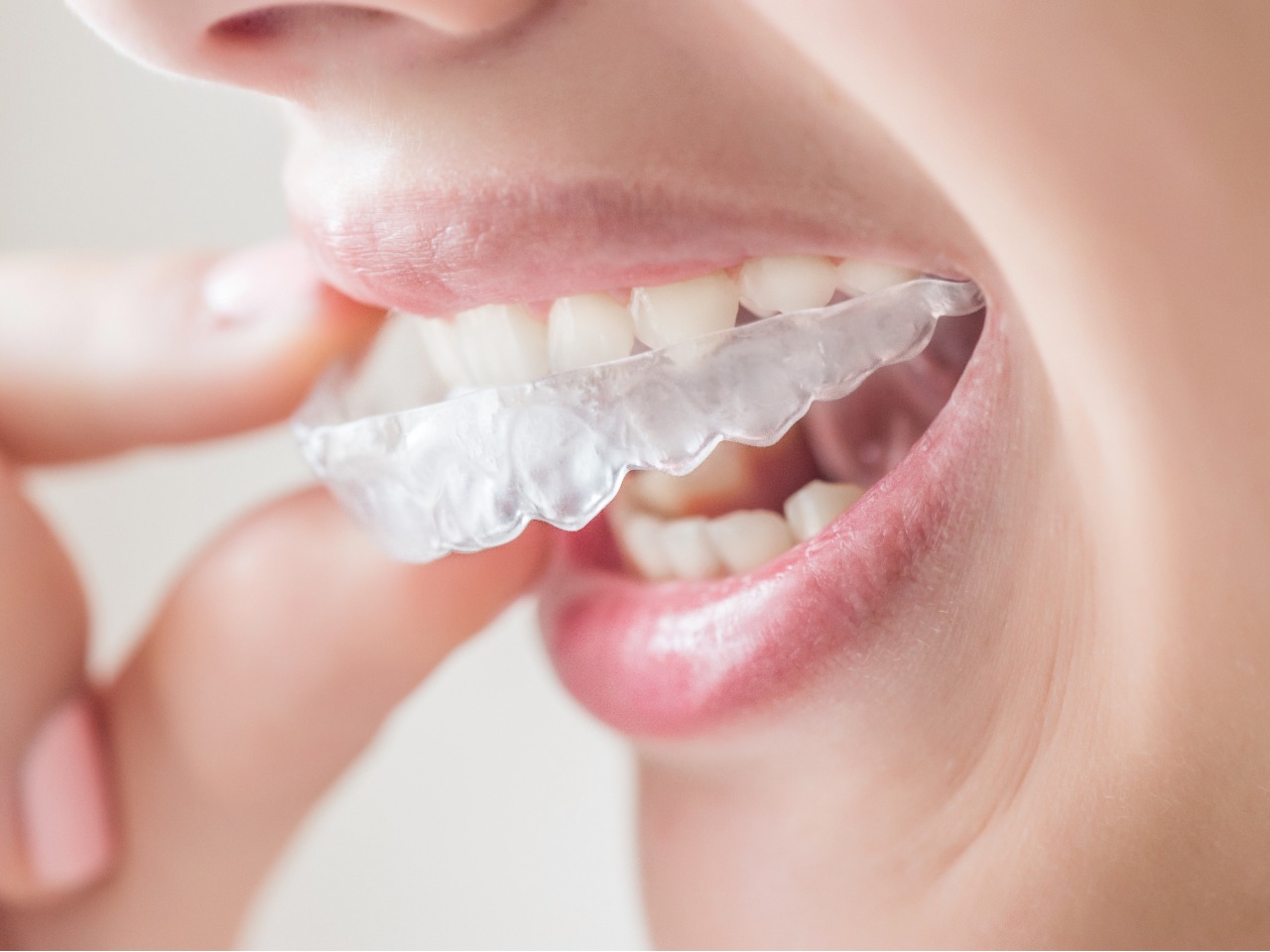 ホームホワイトニング