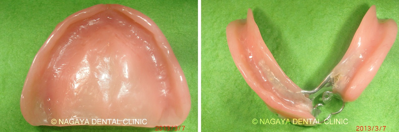 義歯(入れ歯)治療 No.1(以前に装着していた義歯(入れ歯))