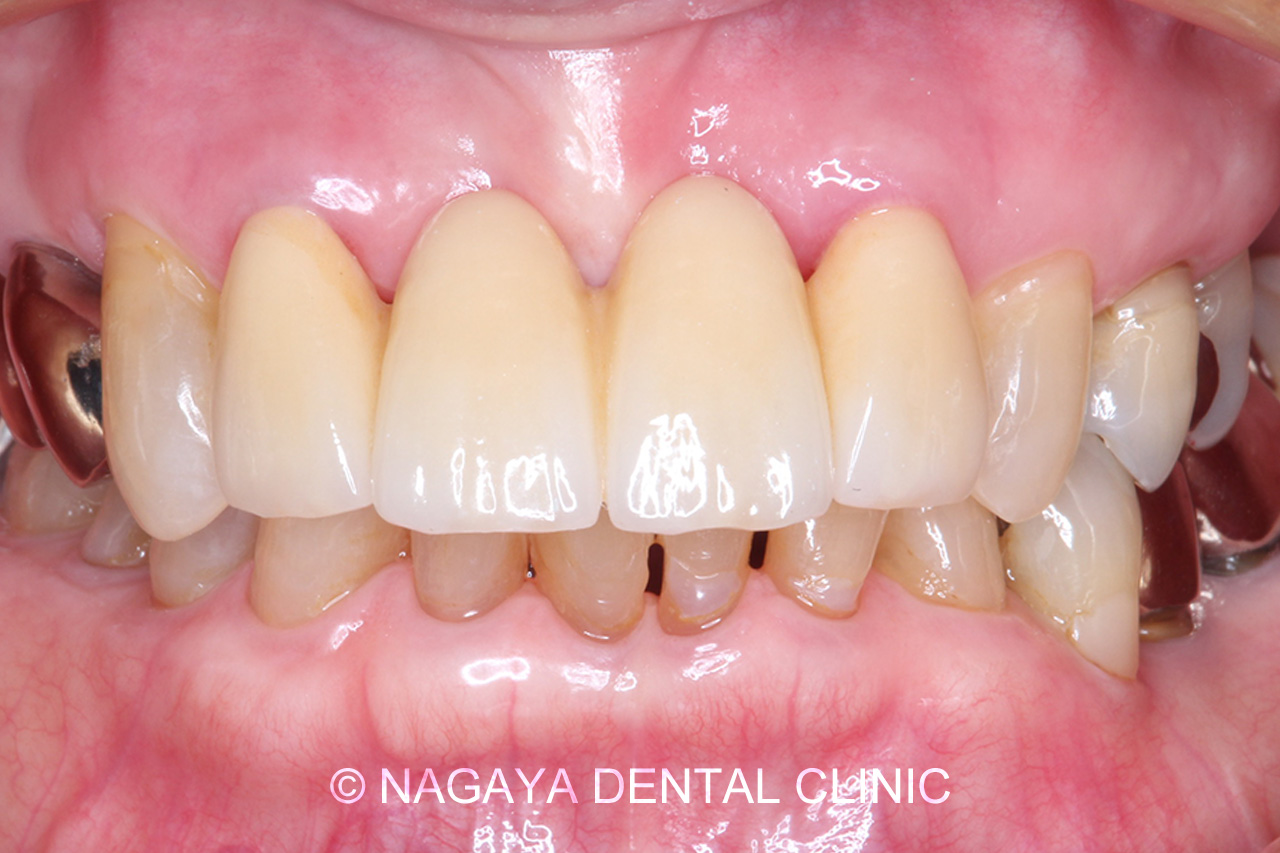 審美・セラミック治療症例 No.1(術後写真)