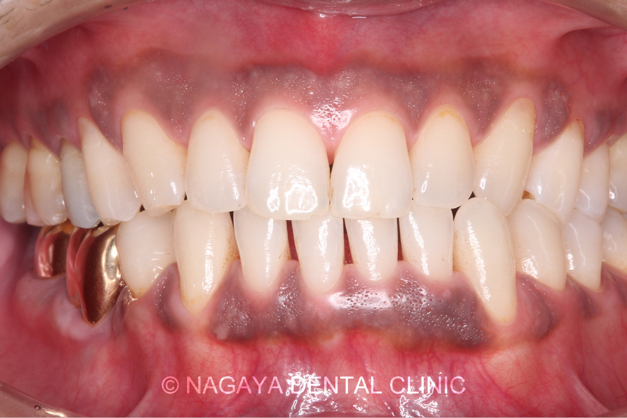 歯肉のホワイトニング施術前