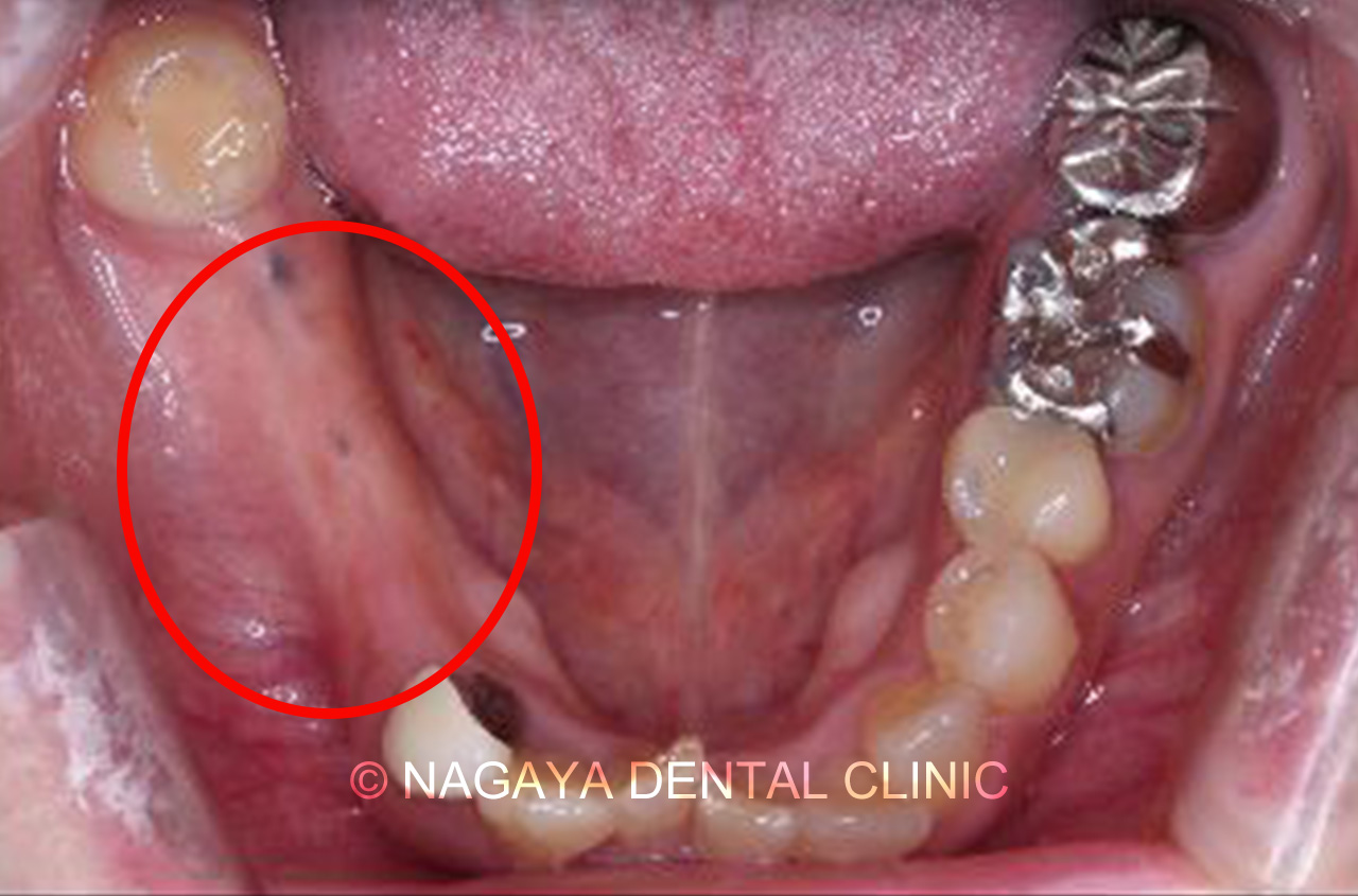 インプラント症例 No.2(術前写真)