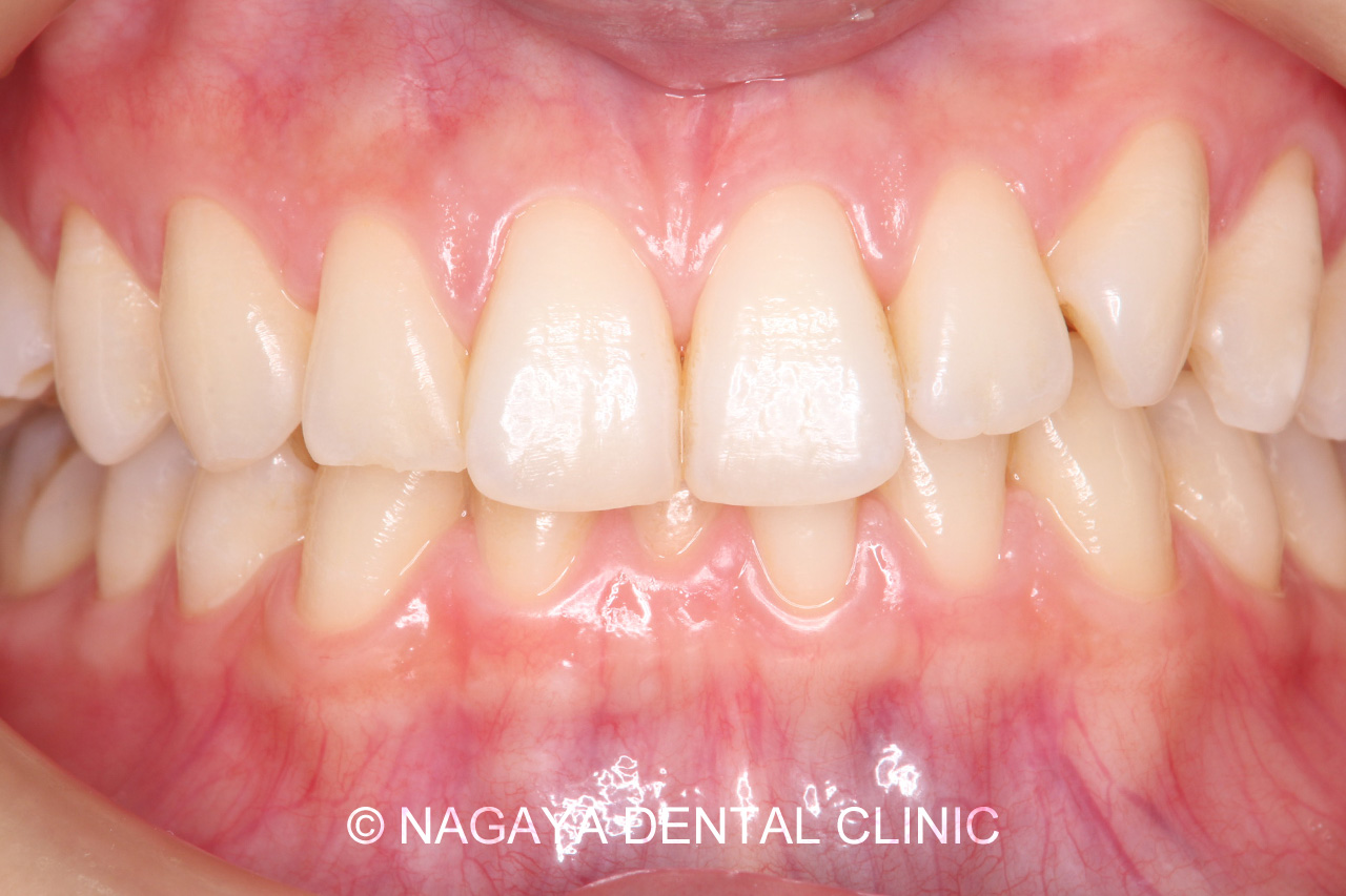 ホワイトニング症例 No.1(術前写真)