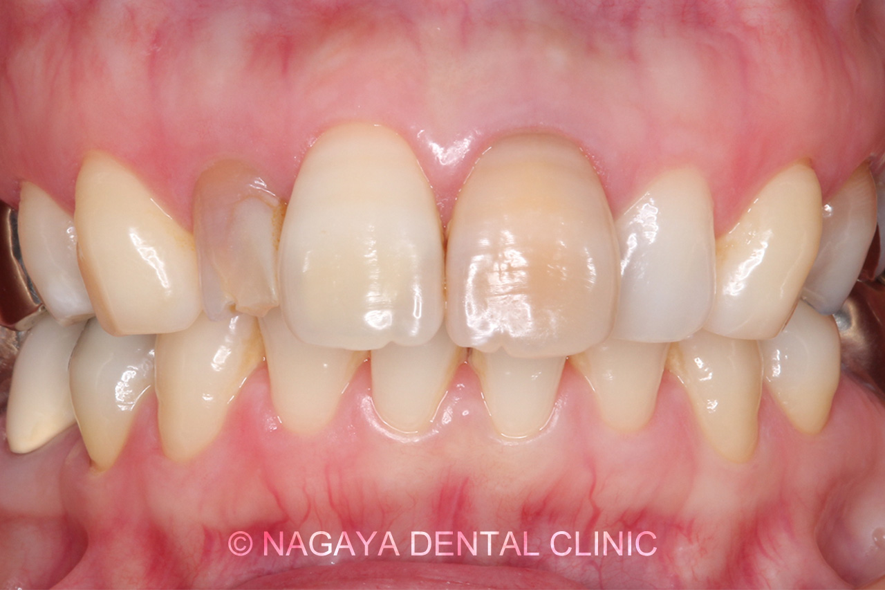 審美・セラミック治療症例 No.2(術前写真)