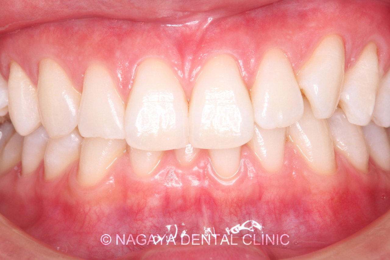 ホワイトニング症例 No.1(術後写真)
