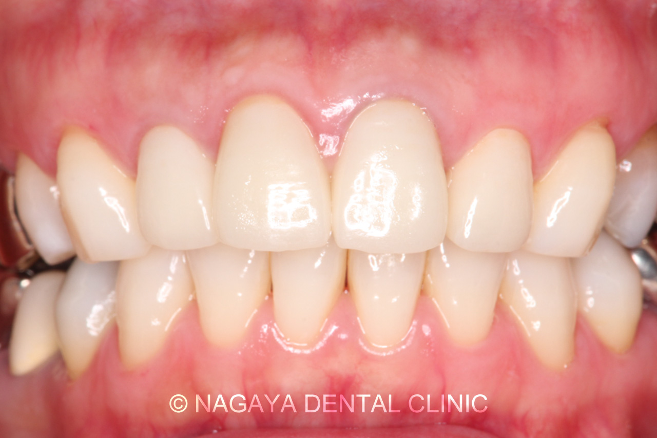 審美・セラミック治療症例 No.2(術後写真)