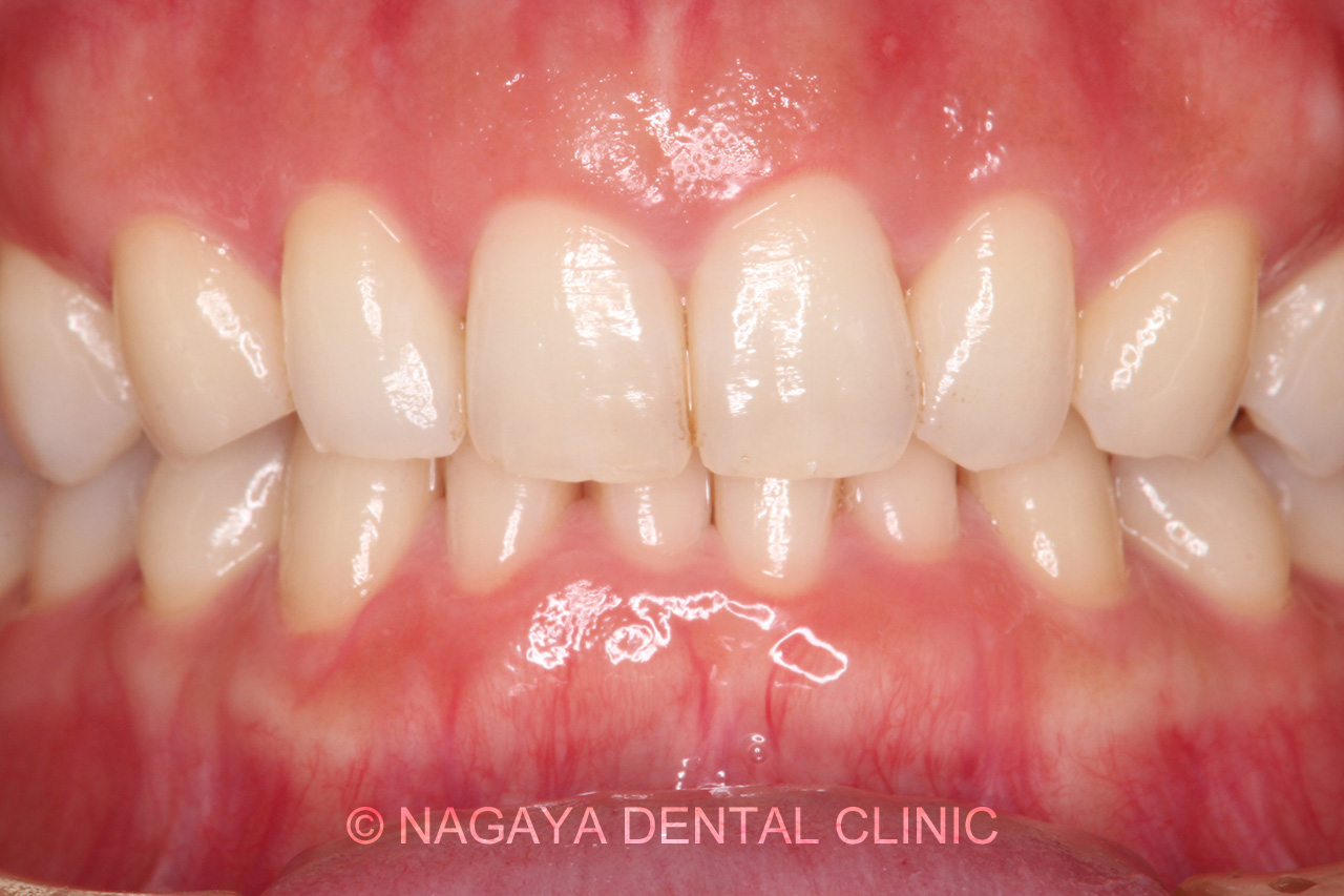 ホワイトニング症例 No.2(術前写真)