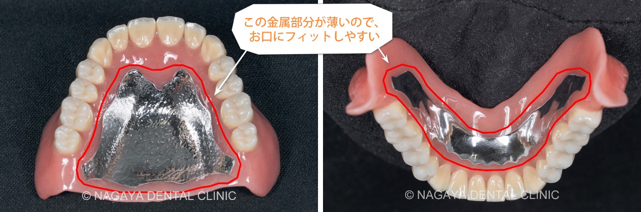義歯(入れ歯)治療 No.1(新しく作成した義歯(入れ歯))