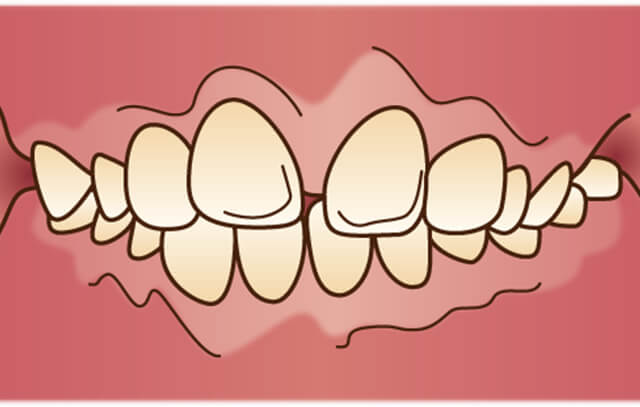 上の歯が出ている