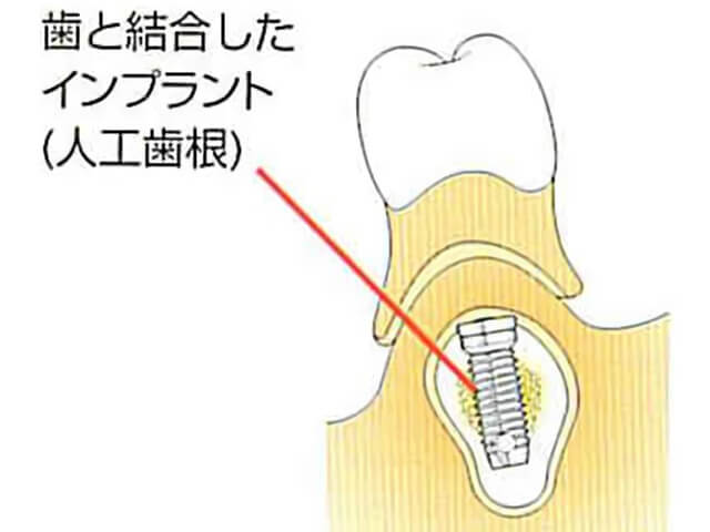 Step3 オッセオインテグレーション:骨結合