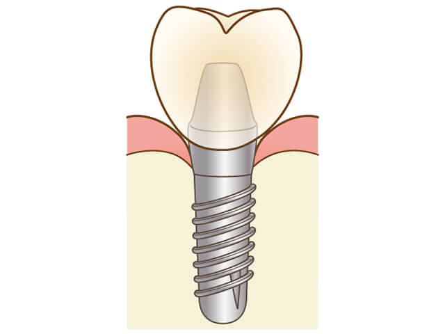 Step6 最終的な歯の装着