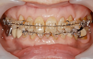 クリアブラケット