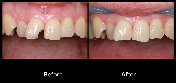 本日は 先生 大変 歯が欠けちゃったの との事でアポイント外でいらした患者さんです ブログページ 青森県八戸市の歯医者 夏堀デンタルクリニック
