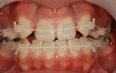 ホワイトコーティング