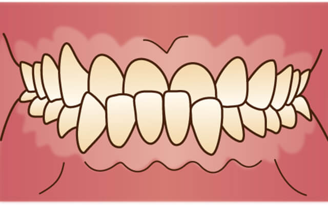 上の歯が出ている