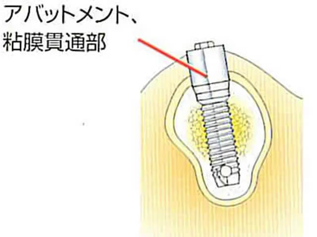 Step4 アバットメント連結(歯冠の土台)