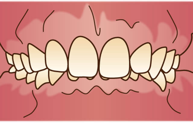 上の歯が下の歯を隠している