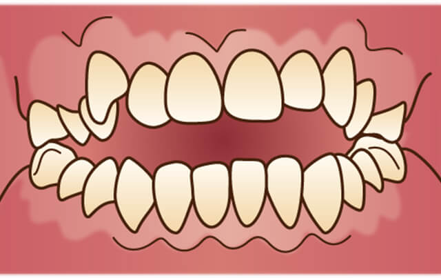 奥歯は咬んでいるが前歯は咬んでいない