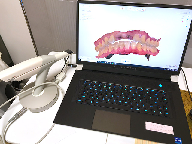 口腔内スキャナー