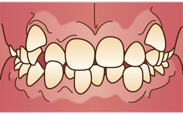 でこぼこした歯ならび