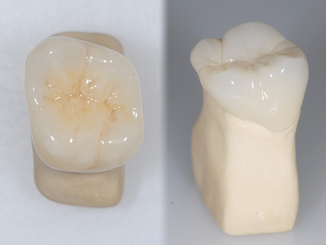 e-max(かぶせもの) ファインセラミックス