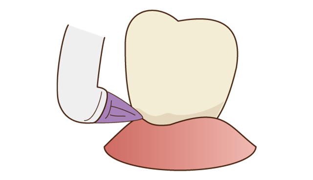 Step1 歯と歯の間の清掃をします。