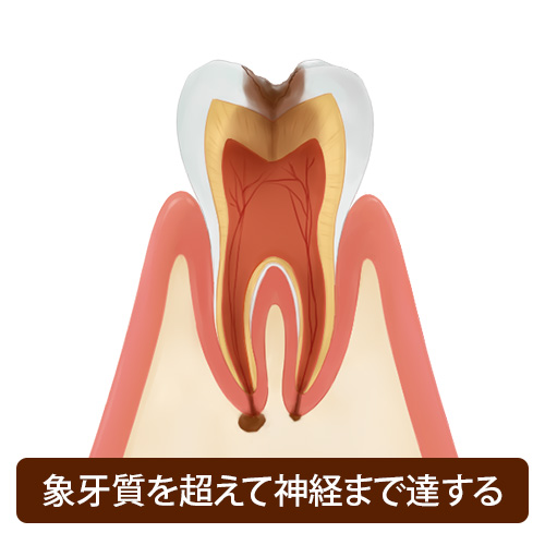 むし歯治療 - 郡山でインプラントなら宝沢伊藤歯科医院