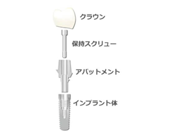 インプラントの構造