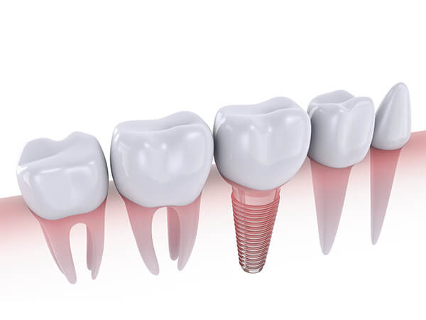インプラントとは
