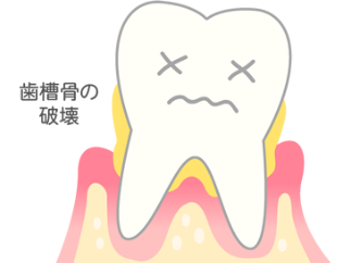 [進行度3] 歯がぐらついてくる