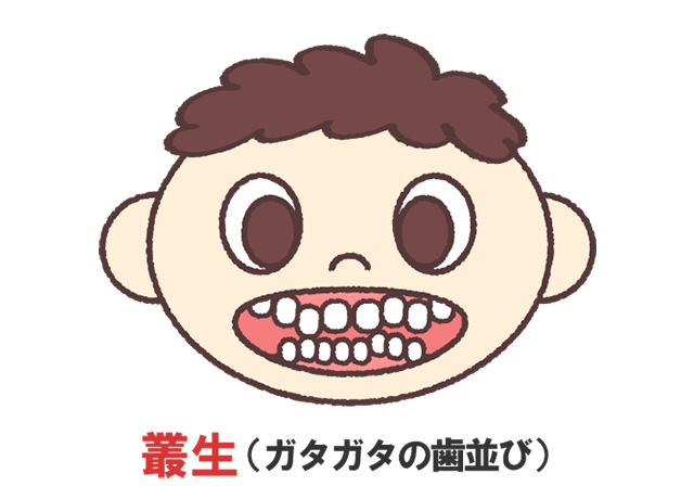 歯並びがガタガタしている
