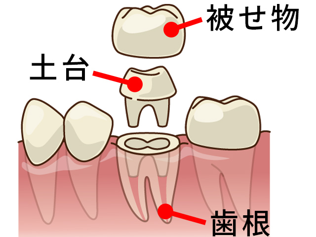 歯の詰め物の種類