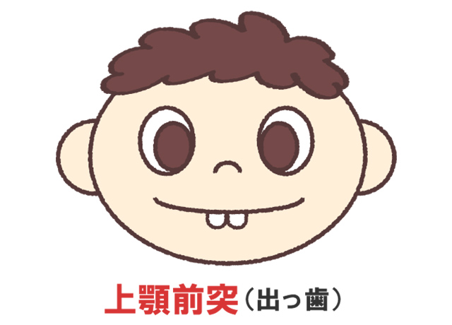 前歯が出ている（出っ歯）