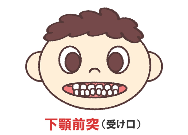 下の歯が前に出ている（受け口）