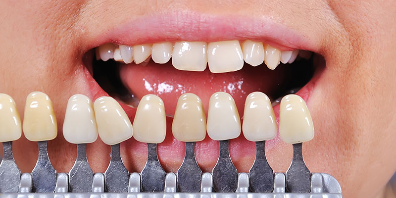 白い歯への修復