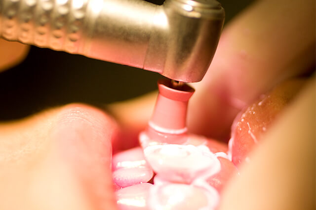 プロによる徹底的なクリーニング「PMTC」