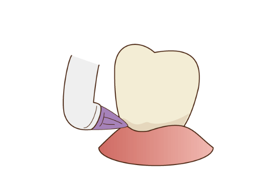 1.チェックと歯間の清掃