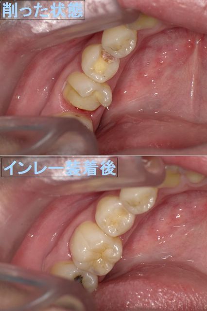 むし歯の治療法（2）