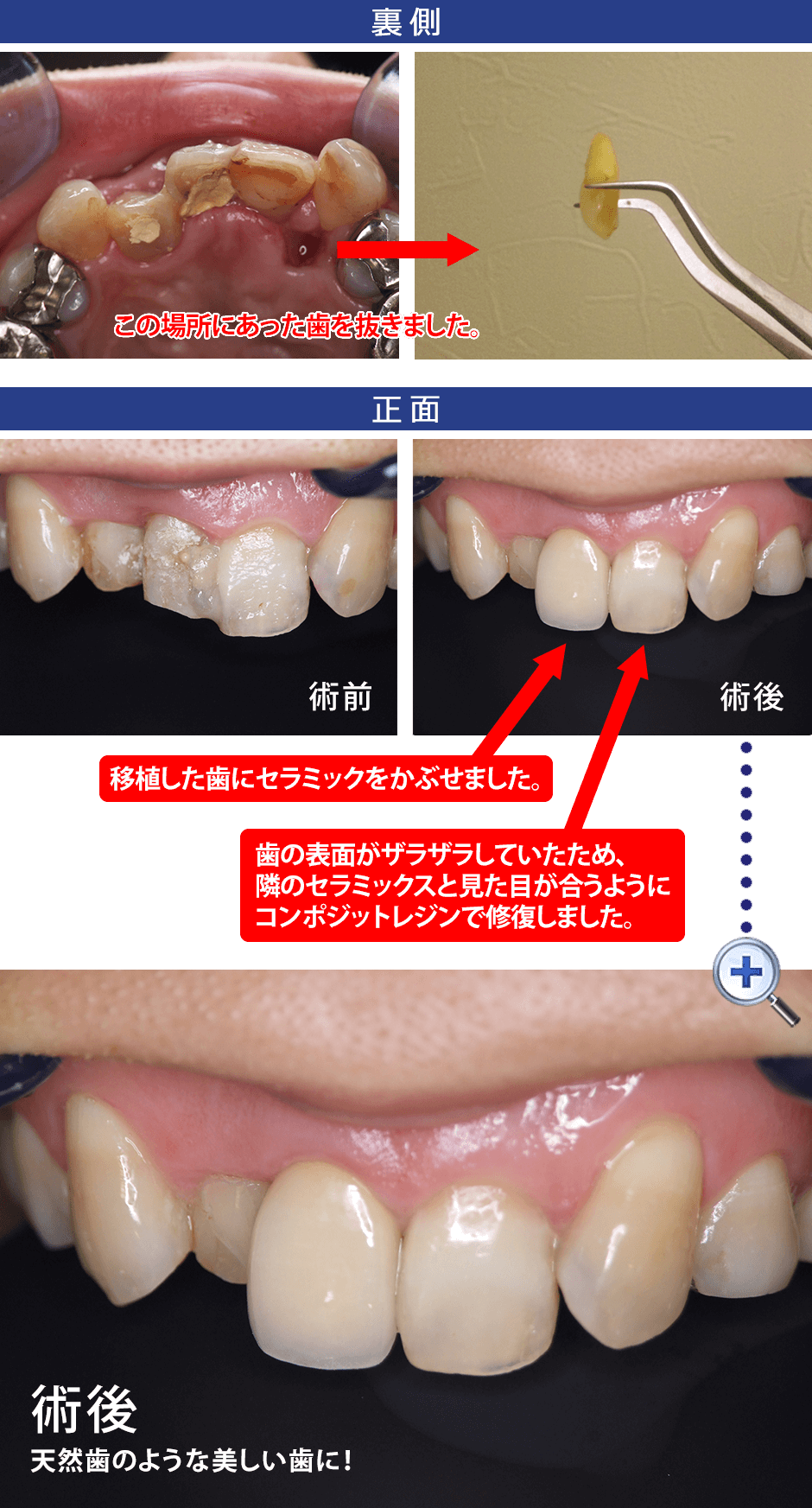 歯の移植 症例