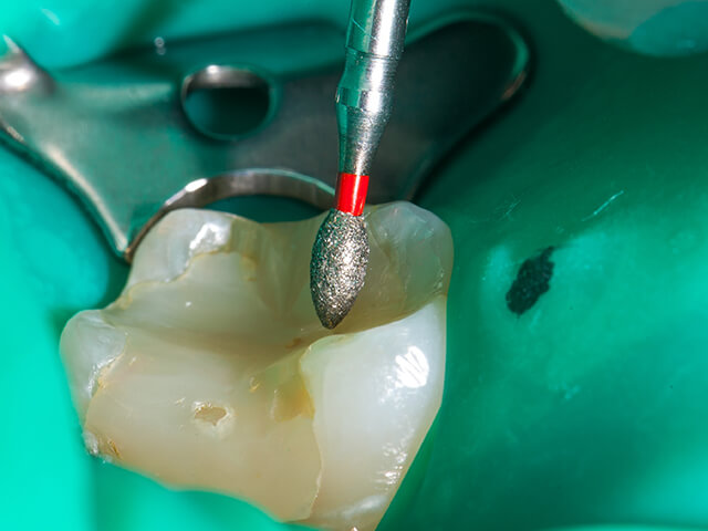大人の虫歯は治療した歯が原因