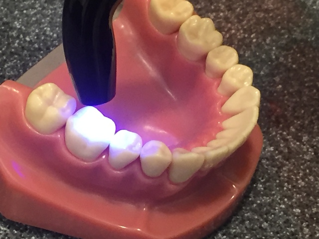むし歯の治療法（１）