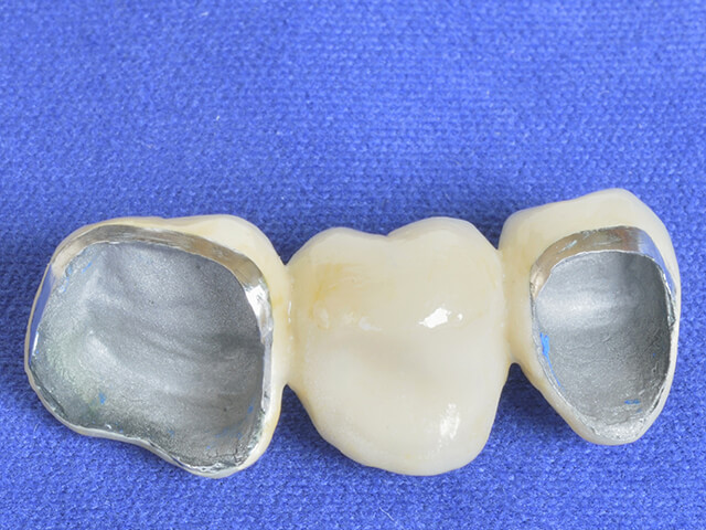 【C4 治療方法】抜歯 → ブリッジ・入れ歯・インプラント