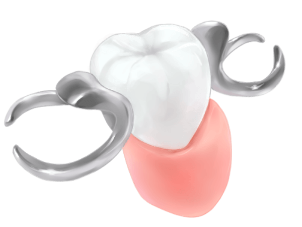 部分入れ歯 (部分義歯)