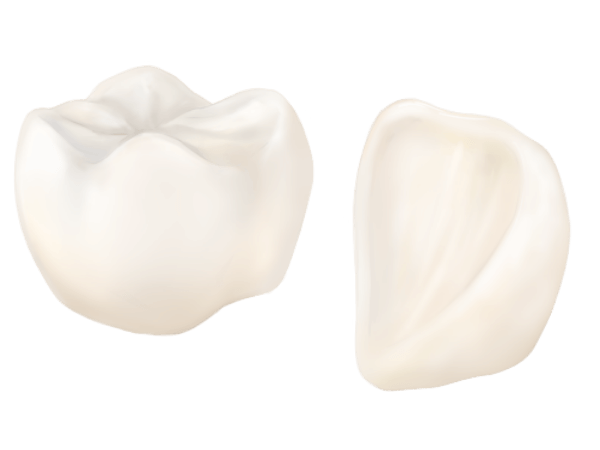 オールセラミック