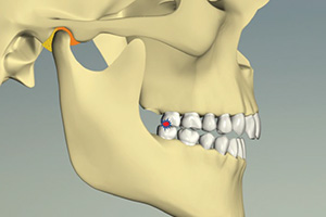 顎関節は安定し、奥歯だけで噛んでいる状態