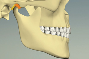 歯がしっかり噛むと、顎関節が浮いている状態