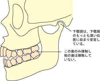 中心位（顎の蝶番運動の回転軸が中心に位置している状態）において、上下の歯が一箇所だけ接触し、他の歯は接触していない場合