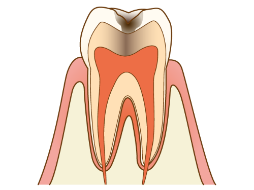 C2 - むし歯の中期状態