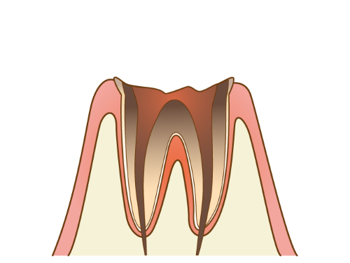 C4 - むし歯の末期状態